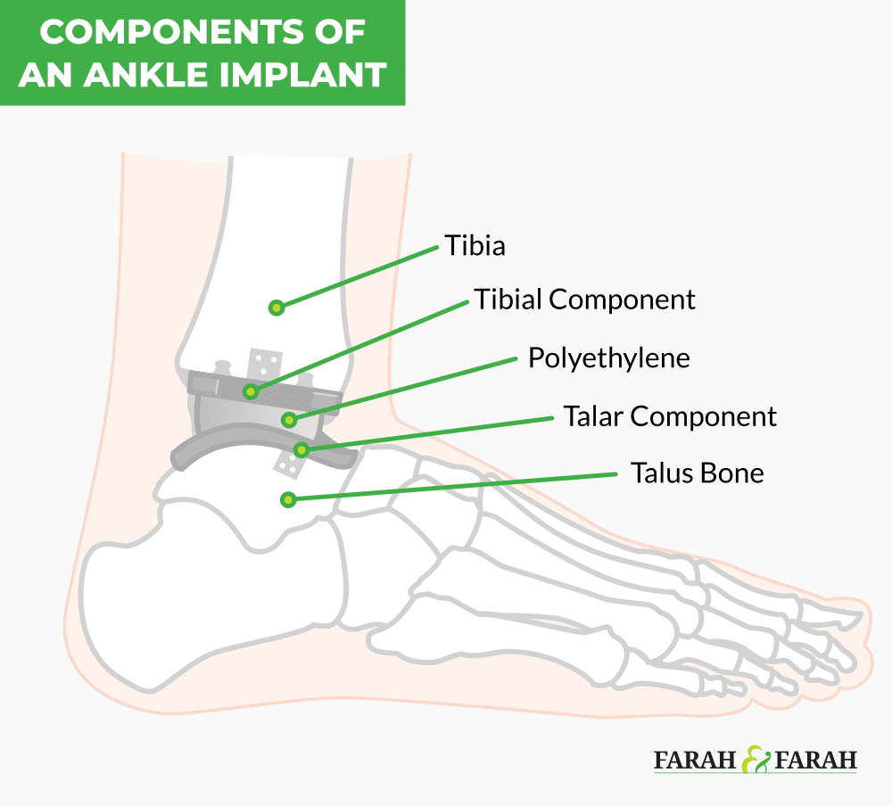 Components of an ankle implant