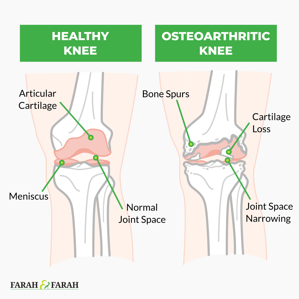 healthy knee vs osteoarthritis knee
